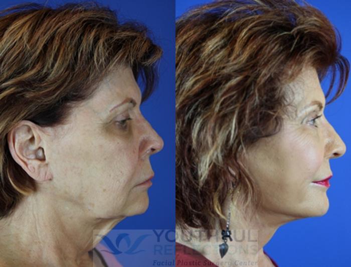 Facelift / Reflection Lift Case 52 Before & After Right Side | Nashville, TN | Youthful Reflections