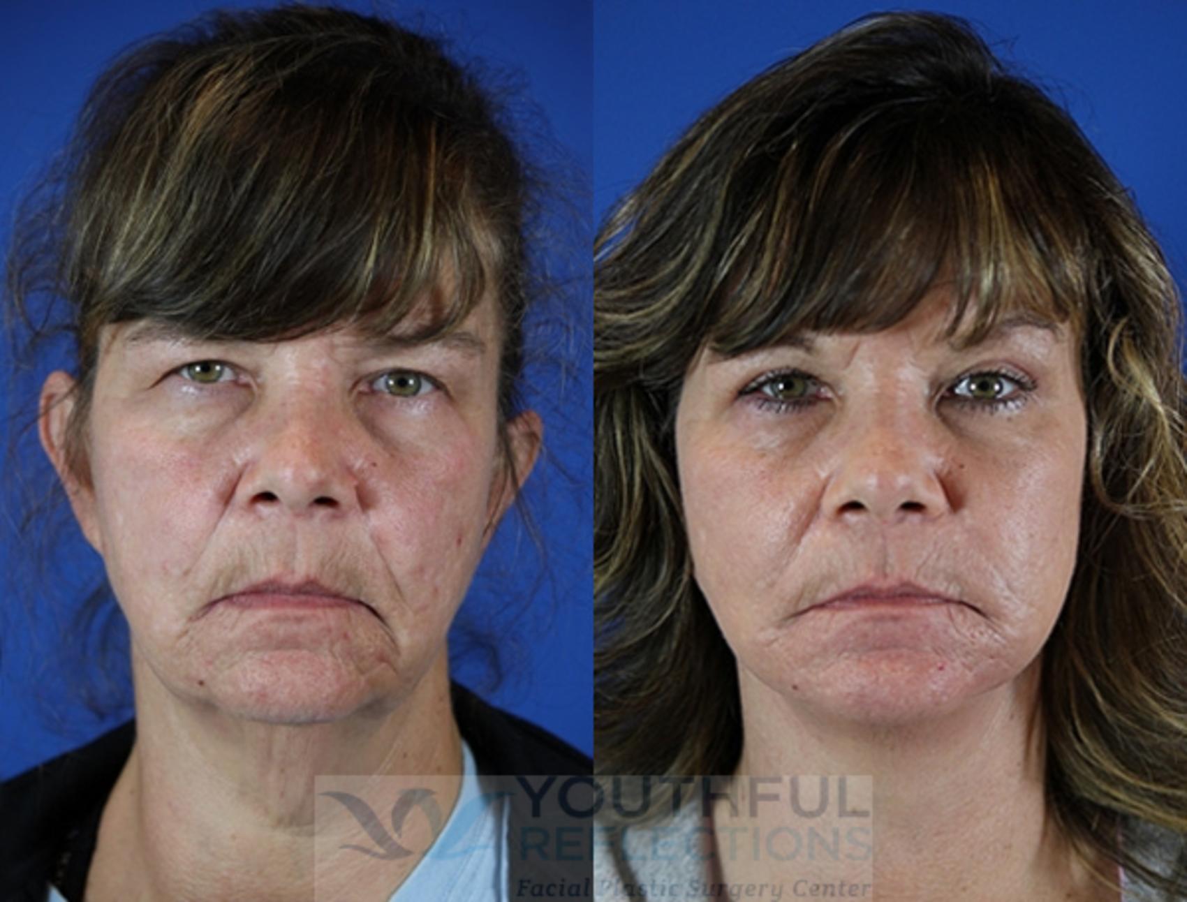 Facelift / Reflection Lift Case 53 Before & After Front | Nashville, TN | Youthful Reflections