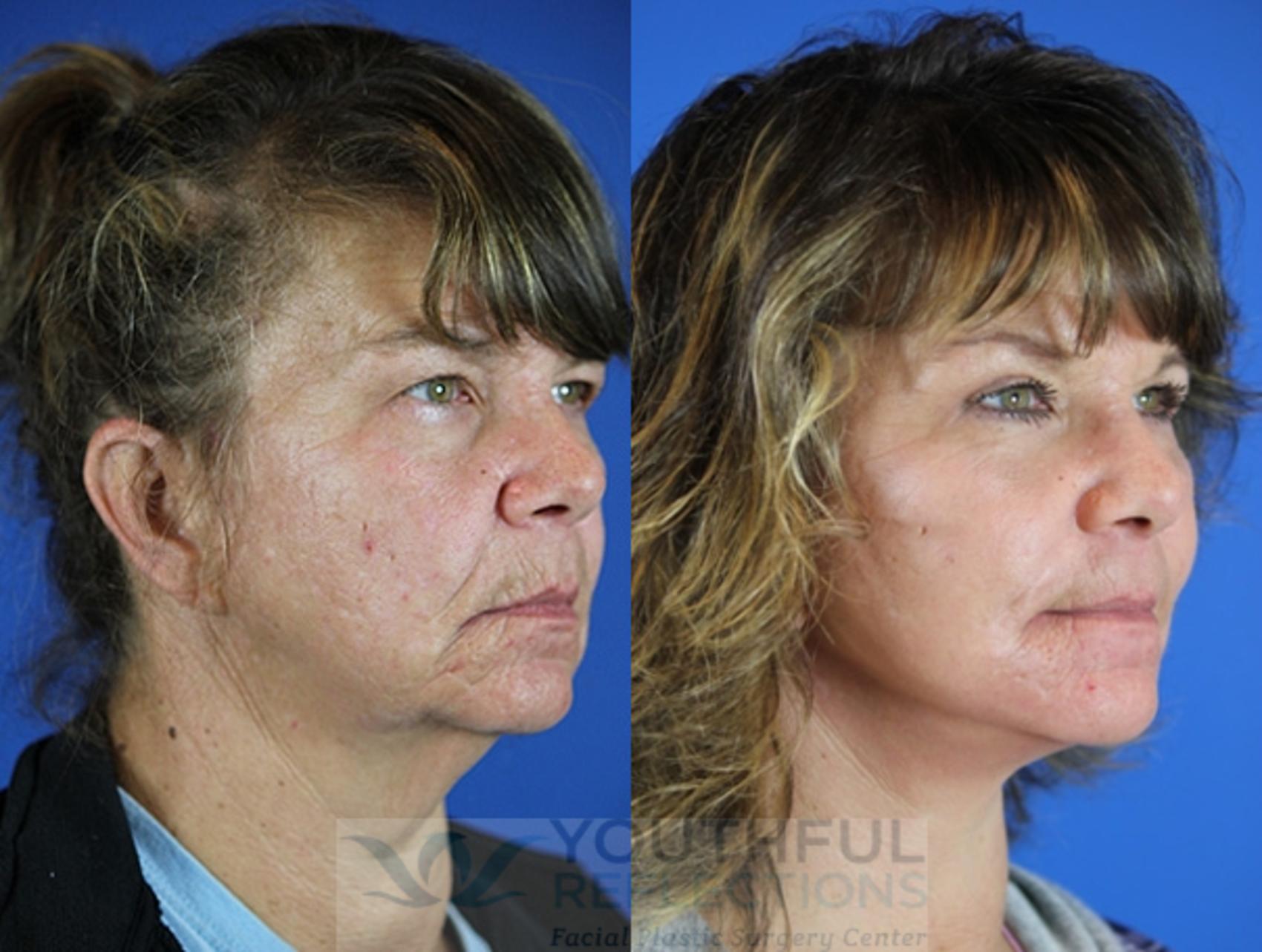 Facelift / Reflection Lift Case 53 Before & After Right Oblique | Nashville, TN | Youthful Reflections
