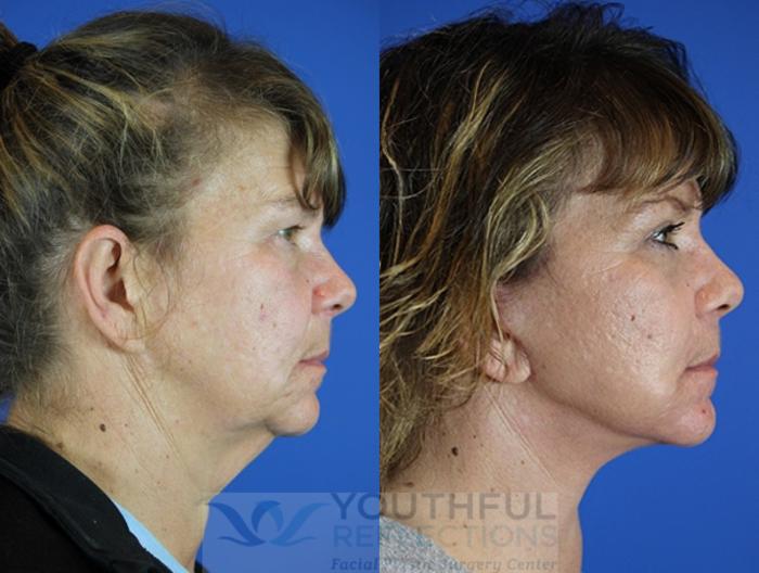 Facelift / Reflection Lift Case 53 Before & After Right Side | Nashville, TN | Youthful Reflections