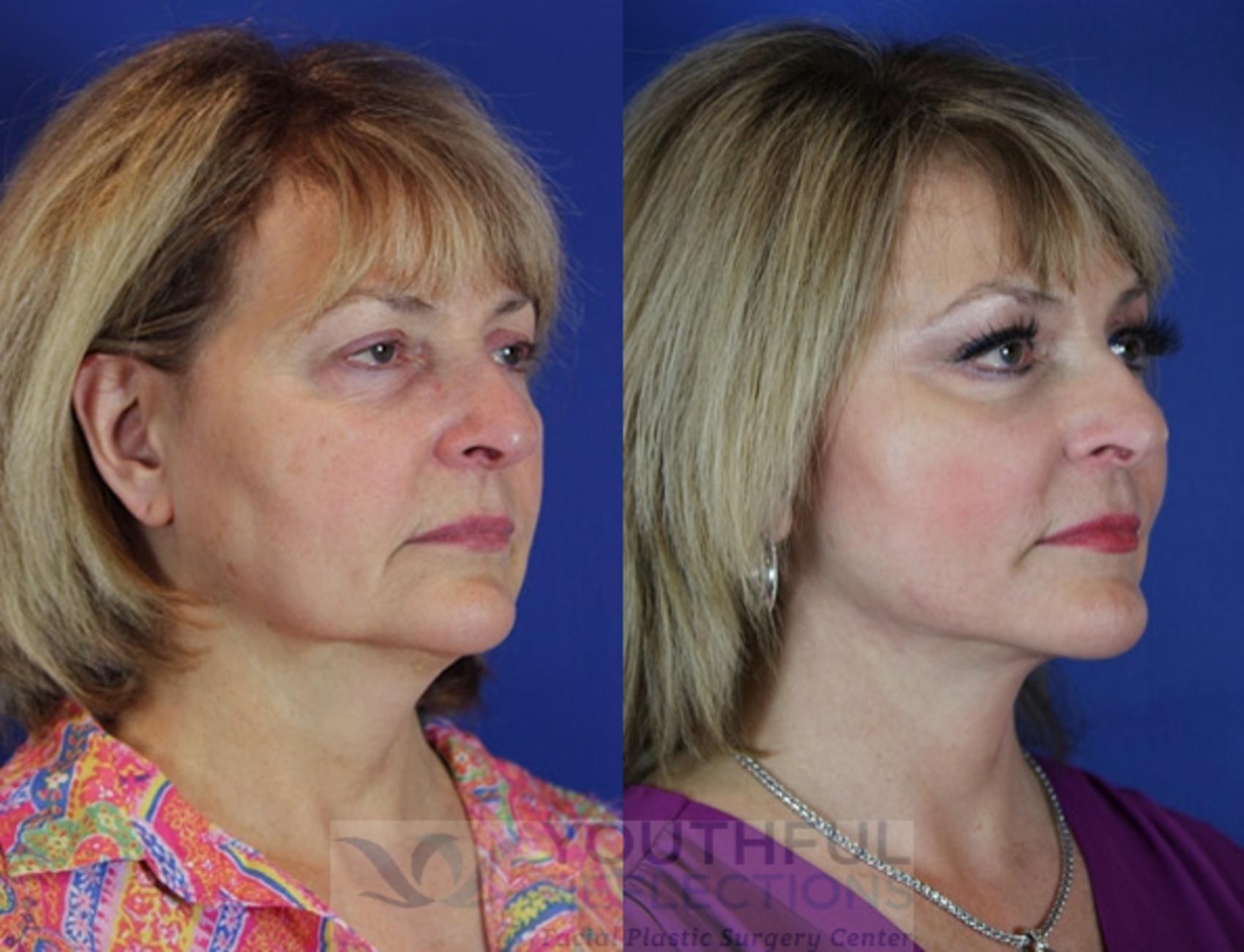 Lower Blepharoplasty Before & After Photos Patient 54 | Nashville, TN ...