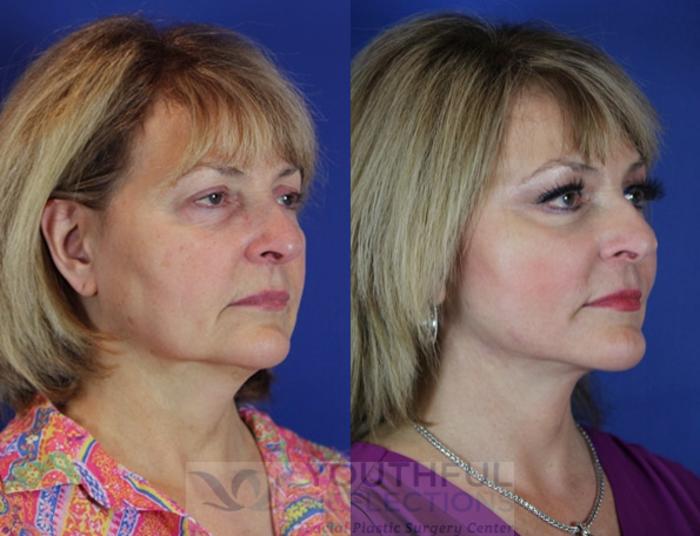 Facelift / Reflection Lift Case 54 Before & After Right Oblique | Nashville, TN | Youthful Reflections