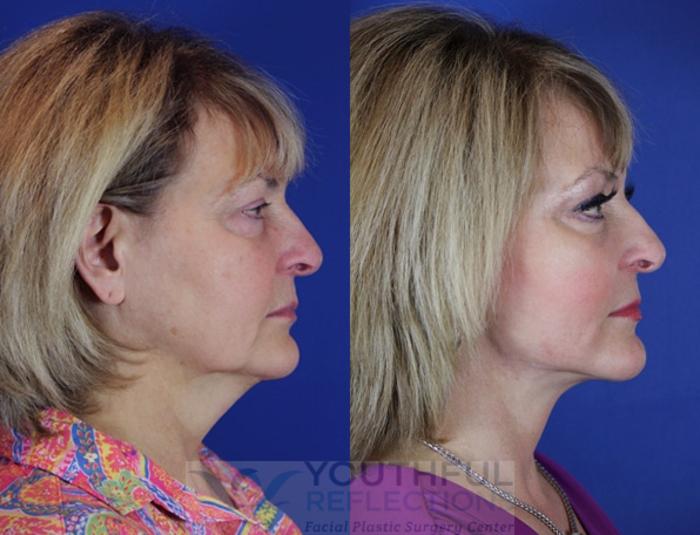 Facelift / Reflection Lift Case 54 Before & After Right Side | Nashville, TN | Youthful Reflections