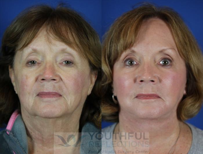 Facelift / Reflection Lift Case 55 Before & After Front | Nashville, TN | Youthful Reflections