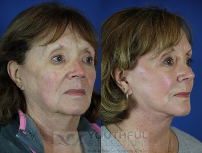 Facelift / Reflection Lift Case 55 Before & After Right Oblique | Nashville, TN | Youthful Reflections