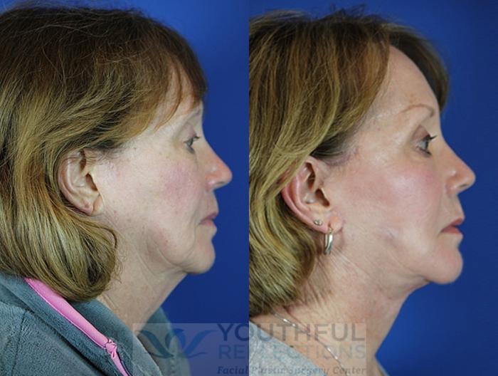Facelift / Reflection Lift Case 55 Before & After Right Side | Nashville, TN | Youthful Reflections