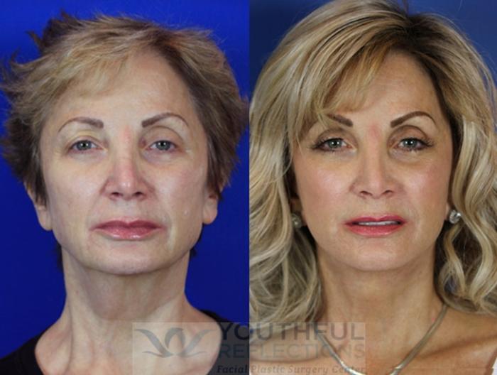 Facelift / Reflection Lift Case 56 Before & After Front | Nashville, TN | Youthful Reflections