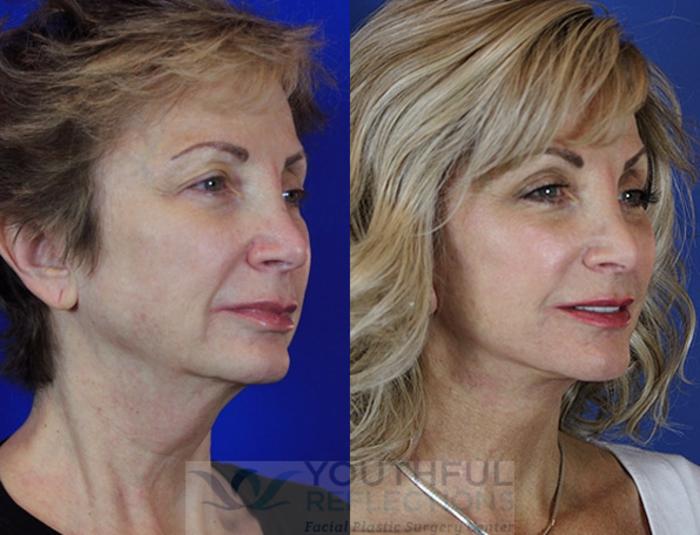 Facelift / Reflection Lift Case 56 Before & After Right Oblique | Nashville, TN | Youthful Reflections