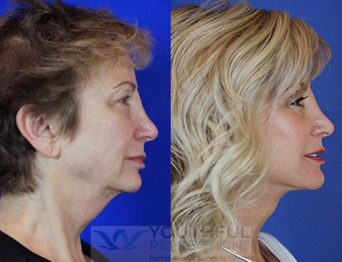 Facelift / Reflection Lift Case 56 Before & After Right Side | Nashville, TN | Youthful Reflections