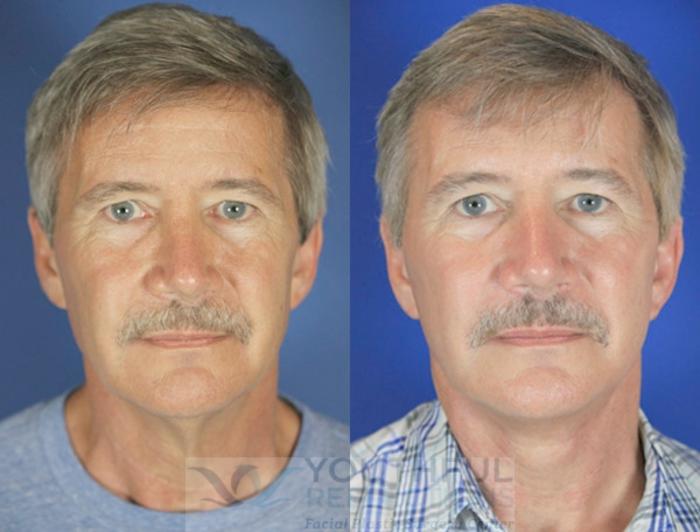 Facelift / Reflection Lift Case 57 Before & After Front | Nashville, TN | Youthful Reflections