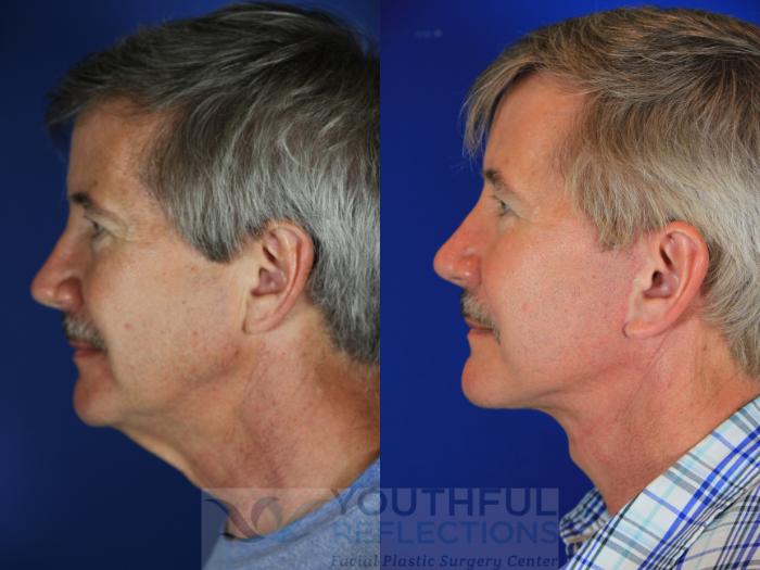 Facelift / Reflection Lift Case 57 Before & After Left Side | Nashville, TN | Youthful Reflections