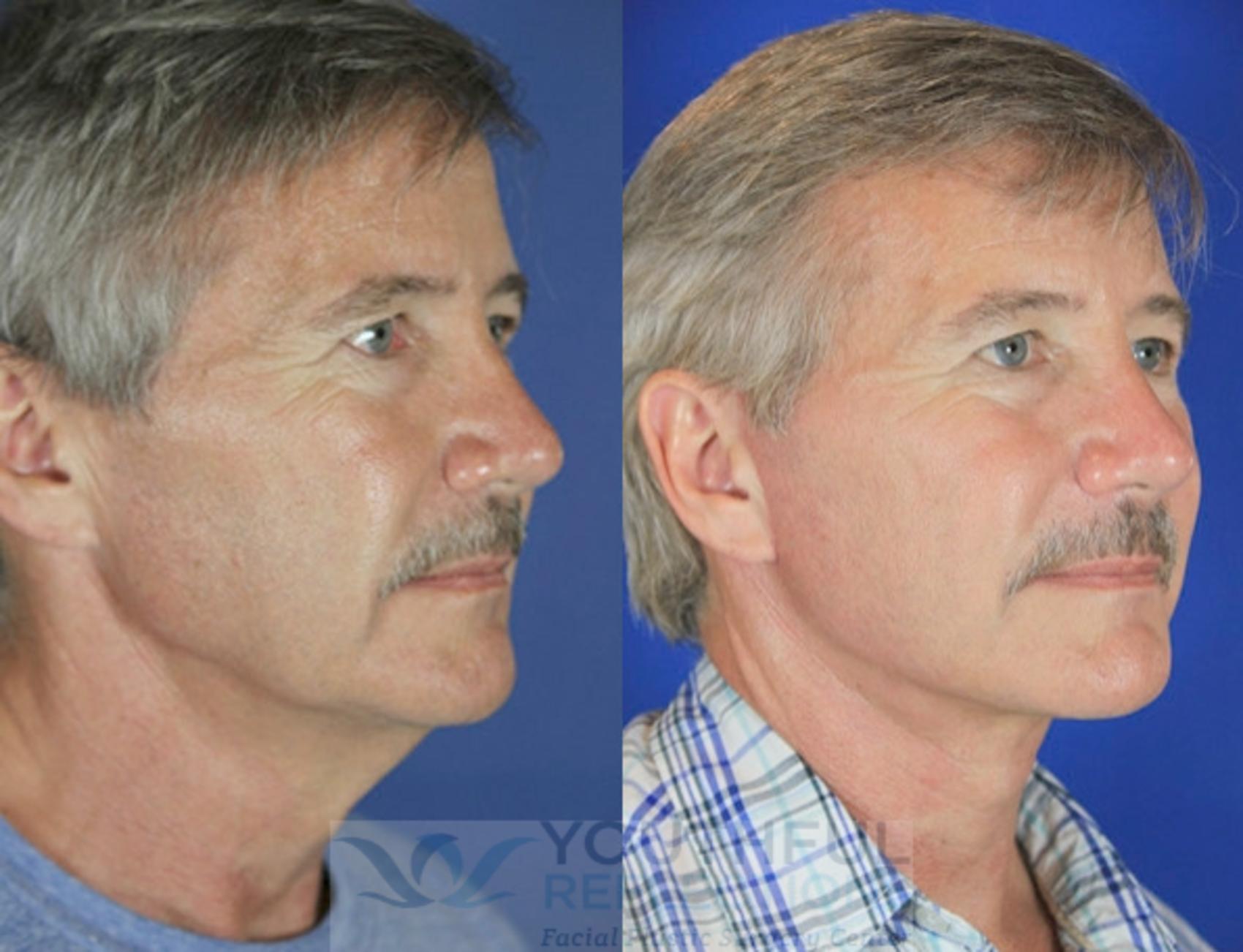Facelift / Reflection Lift Case 57 Before & After Right Oblique | Nashville, TN | Youthful Reflections