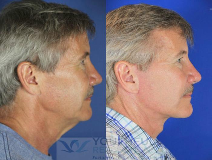 Facelift / Reflection Lift Case 57 Before & After Right Side | Nashville, TN | Youthful Reflections