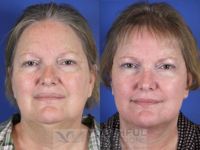 Facelift / Reflection Lift Case 58 Before & After Front | Nashville, TN | Youthful Reflections