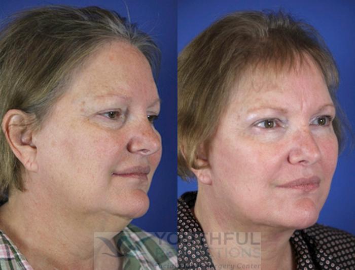 Facelift / Reflection Lift Case 58 Before & After Right Oblique | Nashville, TN | Youthful Reflections
