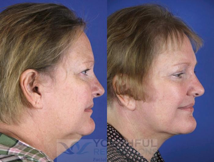 Facelift / Reflection Lift Case 58 Before & After Right Side | Nashville, TN | Youthful Reflections