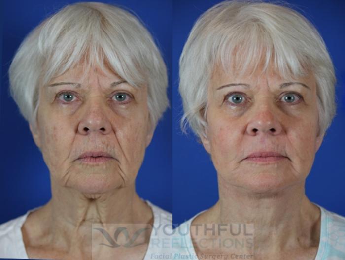 Facelift / Reflection Lift Case 59 Before & After Front | Nashville, TN | Youthful Reflections