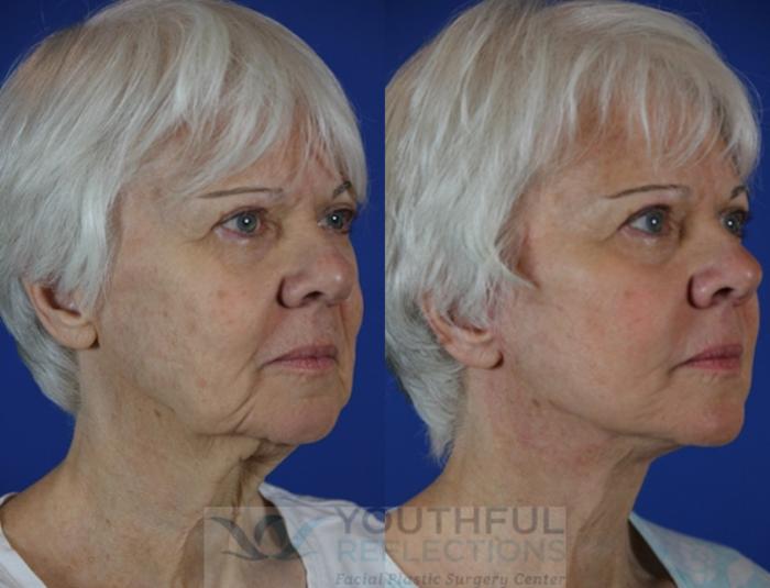 Facelift / Reflection Lift Case 59 Before & After Right Oblique | Nashville, TN | Youthful Reflections