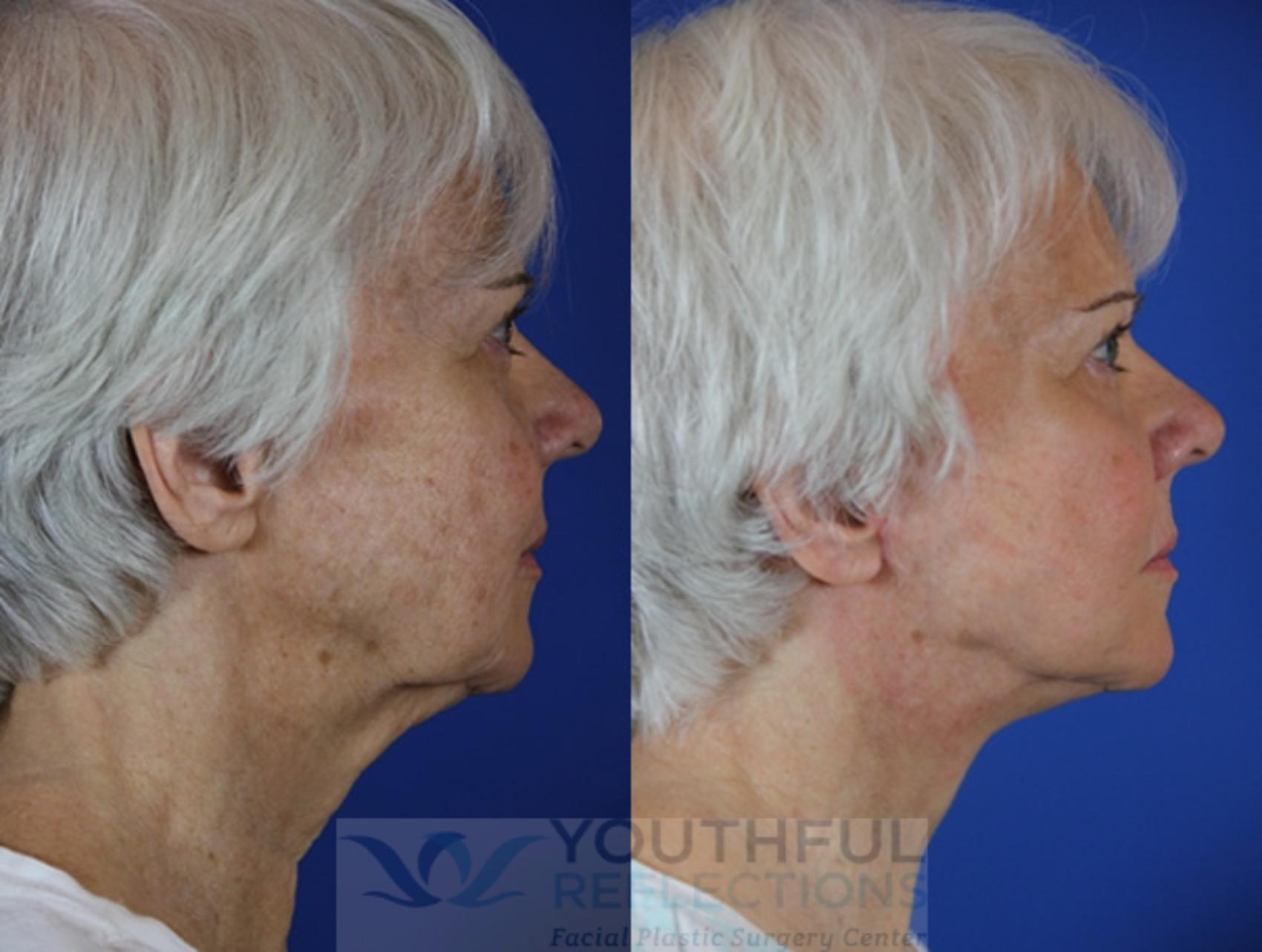 Facelift / Reflection Lift Case 59 Before & After Right Side | Nashville, TN | Youthful Reflections