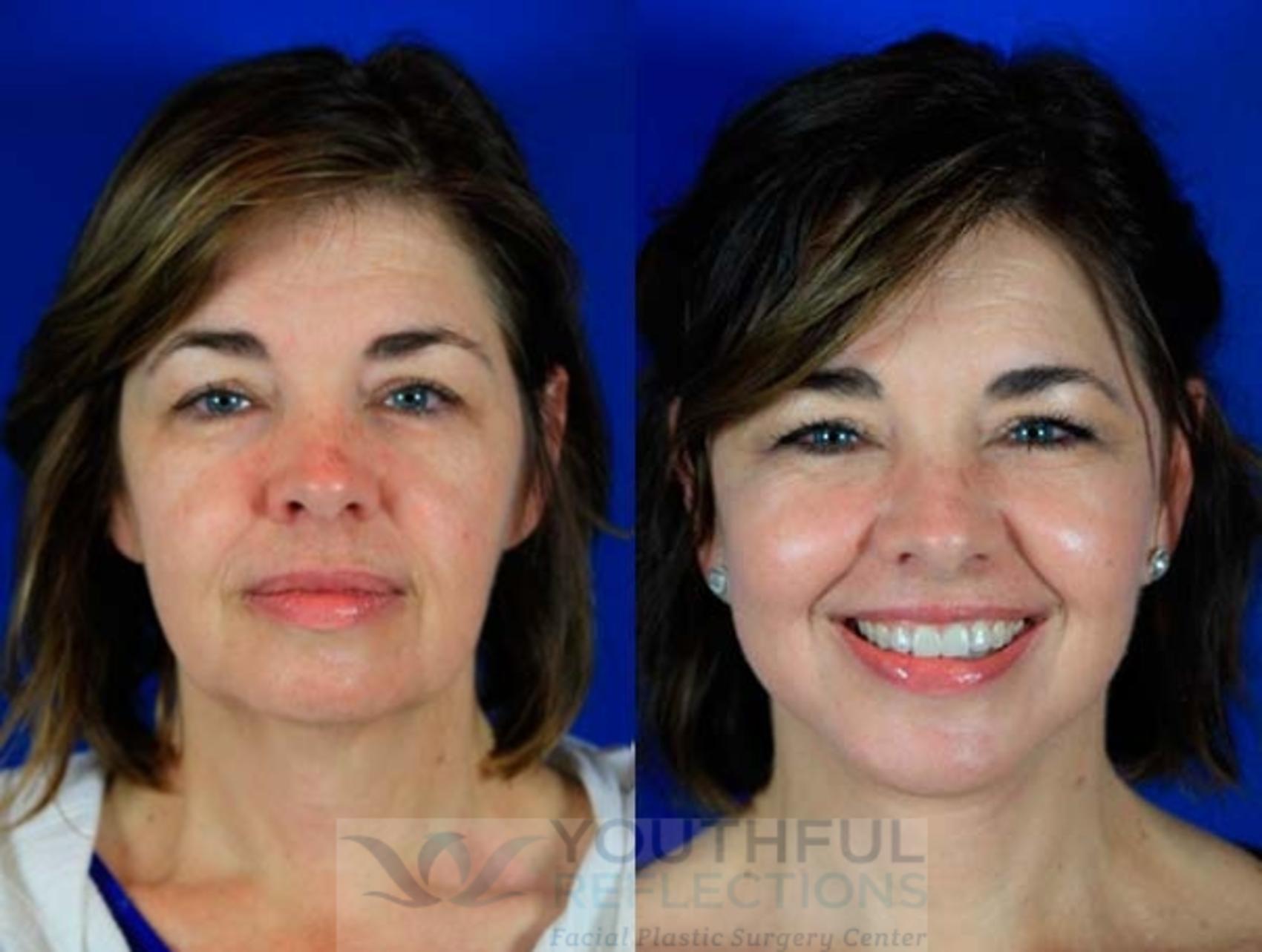 Facelift / Reflection Lift Case 6 Before & After Front | Nashville, TN | Youthful Reflections