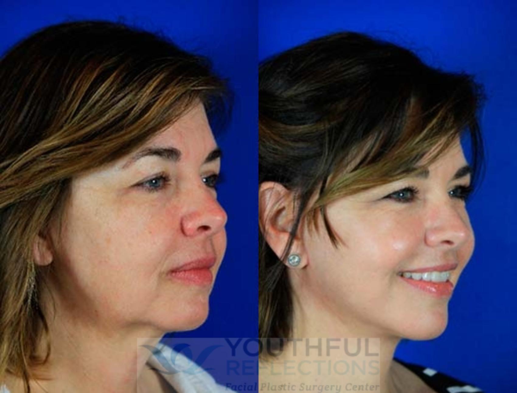Facelift / Reflection Lift Case 6 Before & After Right Oblique | Nashville, TN | Youthful Reflections