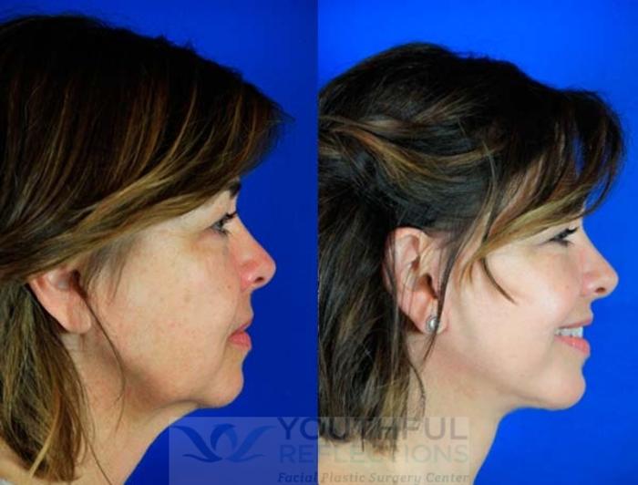 Facelift / Reflection Lift Case 6 Before & After Right Side | Nashville, TN | Youthful Reflections