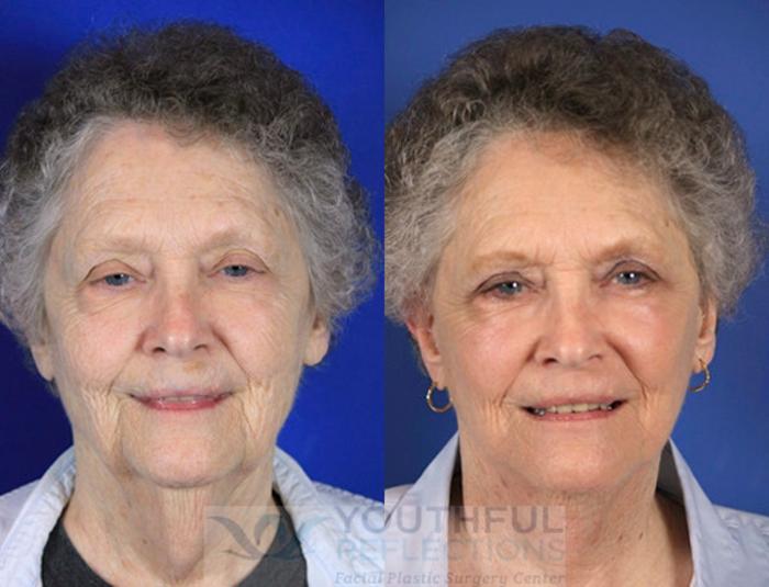 Facelift / Reflection Lift Case 60 Before & After Front | Nashville, TN | Youthful Reflections