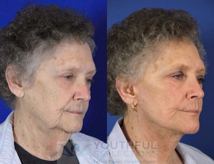 Facelift / Reflection Lift Case 60 Before & After Right Oblique | Nashville, TN | Youthful Reflections