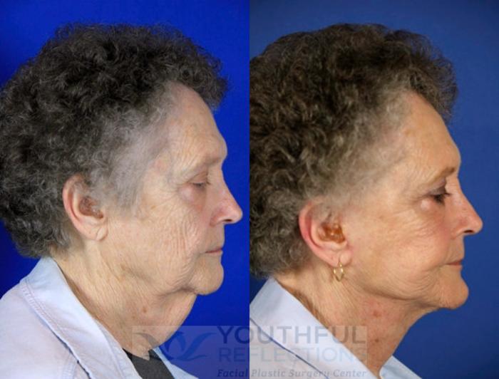 Facelift / Reflection Lift Case 60 Before & After Right Side | Nashville, TN | Youthful Reflections