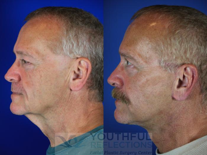 Facelift / Reflection Lift Case 62 Before & After Left Side | Nashville, TN | Youthful Reflections