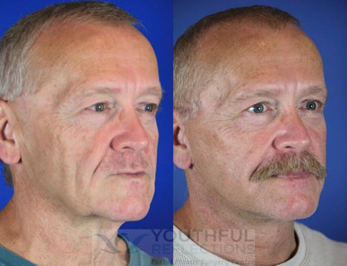 Facelift / Reflection Lift Case 62 Before & After Right Oblique | Nashville, TN | Youthful Reflections