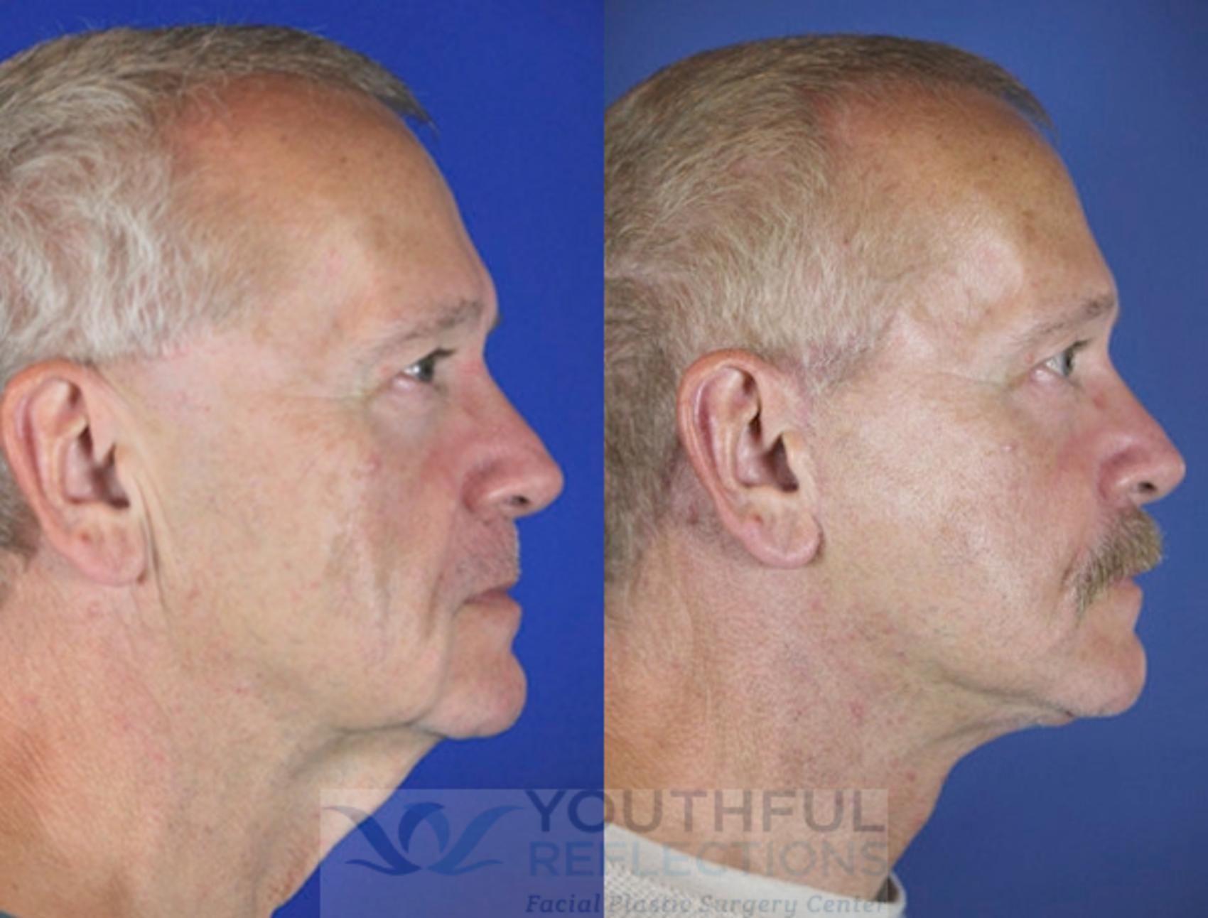 Facelift / Reflection Lift Case 62 Before & After Right Side | Nashville, TN | Youthful Reflections