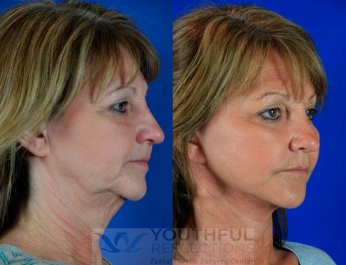 CO2 Laser Skin Resurfacing Case 63 Before & After Right Oblique | Nashville, TN | Youthful Reflections