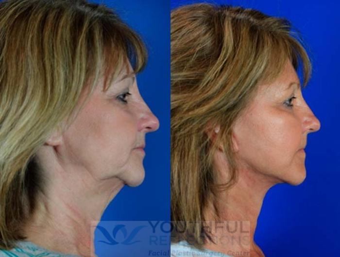 CO2 Laser Skin Resurfacing Case 63 Before & After Right Side | Nashville, TN | Youthful Reflections
