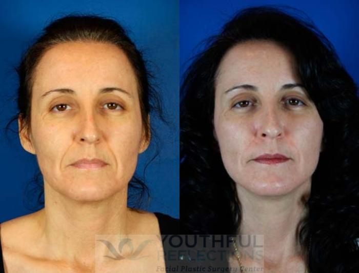 Facelift / Reflection Lift Case 65 Before & After Front | Nashville, TN | Youthful Reflections