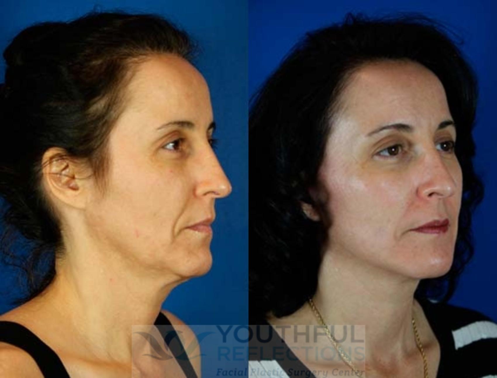 Fat Transfer Case 65 Before & After Right Oblique | Nashville, TN | Youthful Reflections