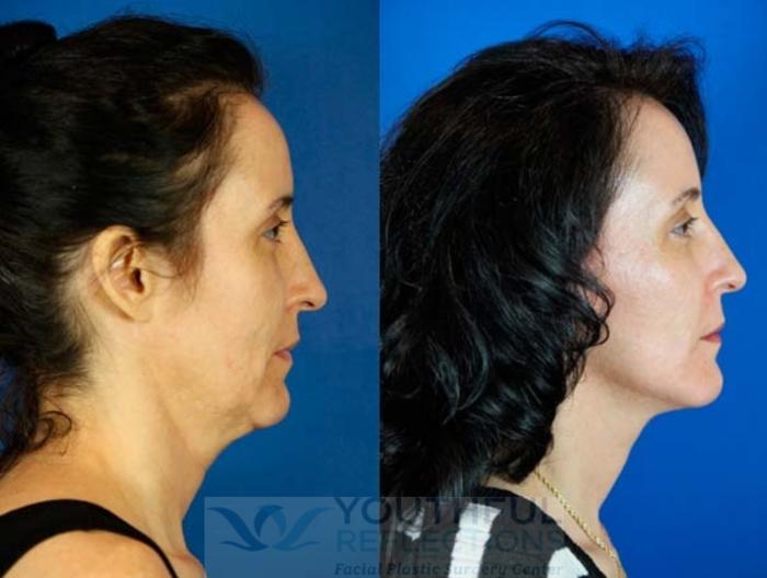 Facelift / Reflection Lift Case 65 Before & After Right Side | Nashville, TN | Youthful Reflections