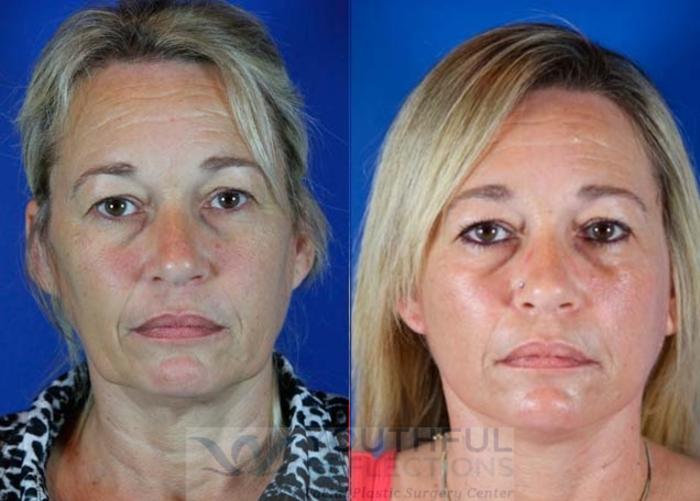 Facelift / Reflection Lift Case 66 Before & After Front | Nashville, TN | Youthful Reflections