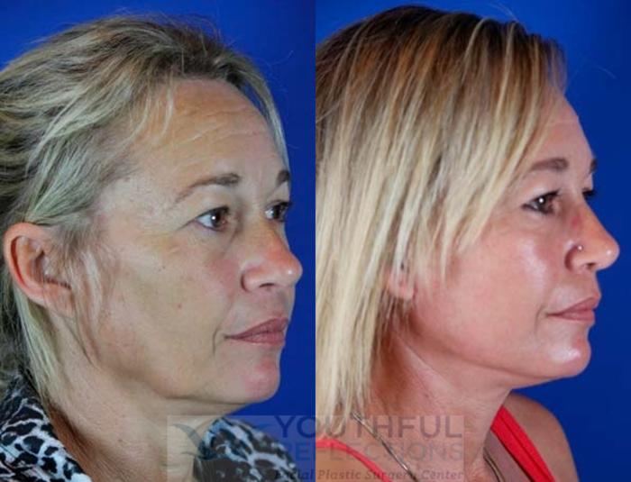Facelift / Reflection Lift Case 66 Before & After Right Oblique | Nashville, TN | Youthful Reflections