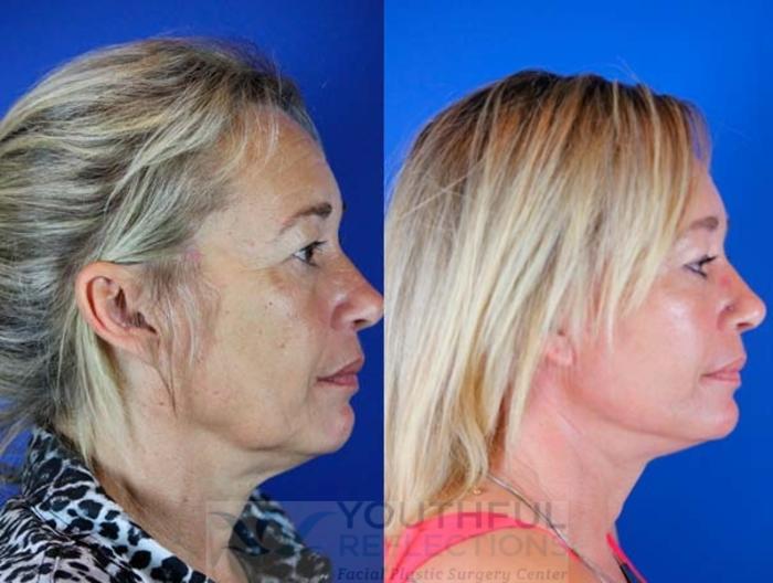 Facelift / Reflection Lift Case 66 Before & After Right Side | Nashville, TN | Youthful Reflections