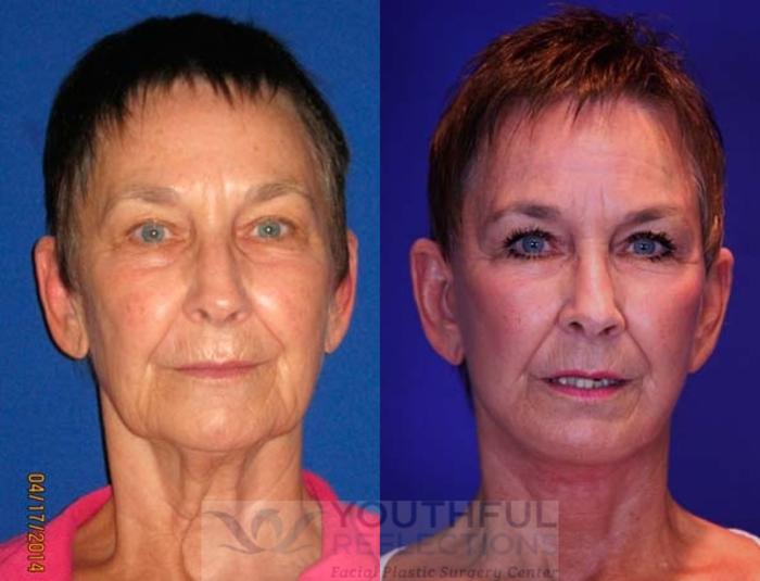 Facelift / Reflection Lift Case 67 Before & After Front | Nashville, TN | Youthful Reflections
