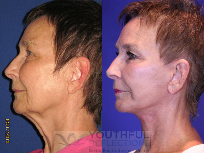 Facelift / Reflection Lift Case 67 Before & After Left Side | Nashville, TN | Youthful Reflections