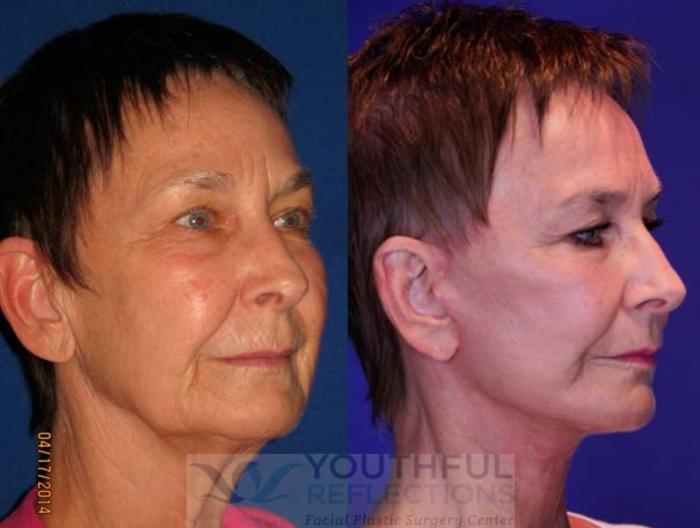 Facelift / Reflection Lift Case 67 Before & After Right Oblique | Nashville, TN | Youthful Reflections