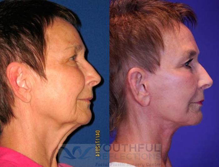 Facelift / Reflection Lift Case 67 Before & After Right Side | Nashville, TN | Youthful Reflections