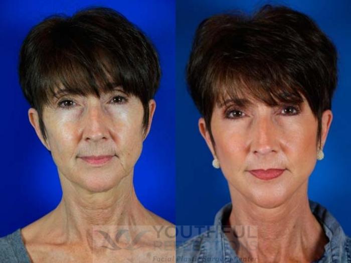 Facelift / Reflection Lift Case 68 Before & After Front 2 | Nashville, TN | Youthful Reflections