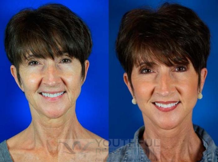 Facelift / Reflection Lift Case 68 Before & After Front | Nashville, TN | Youthful Reflections