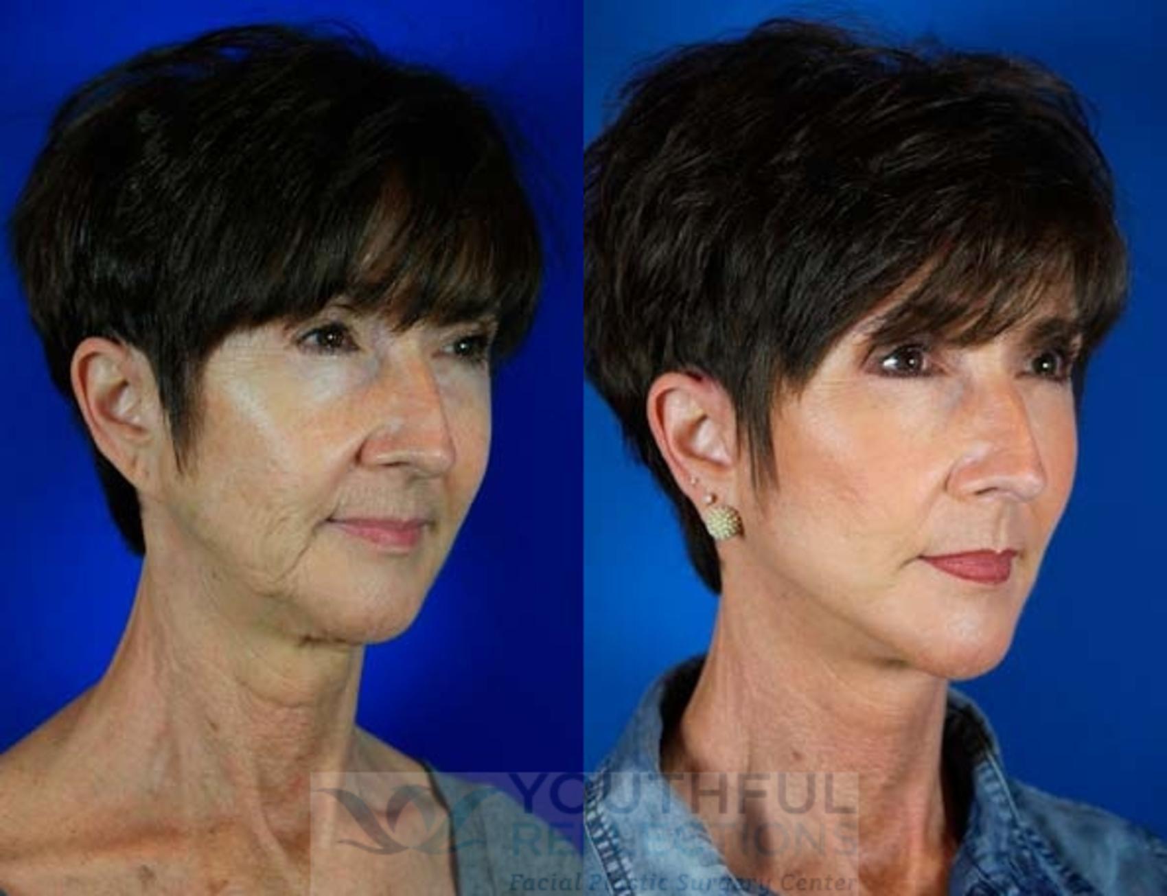 Facelift / Reflection Lift Case 68 Before & After Right Oblique | Nashville, TN | Youthful Reflections