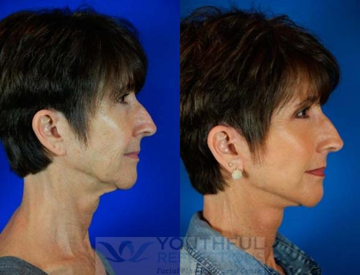 Facelift / Reflection Lift Case 68 Before & After Right Side | Nashville, TN | Youthful Reflections