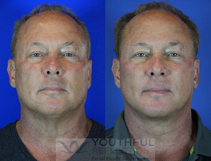 Facelift / Reflection Lift Case 69 Before & After Front | Nashville, TN | Youthful Reflections