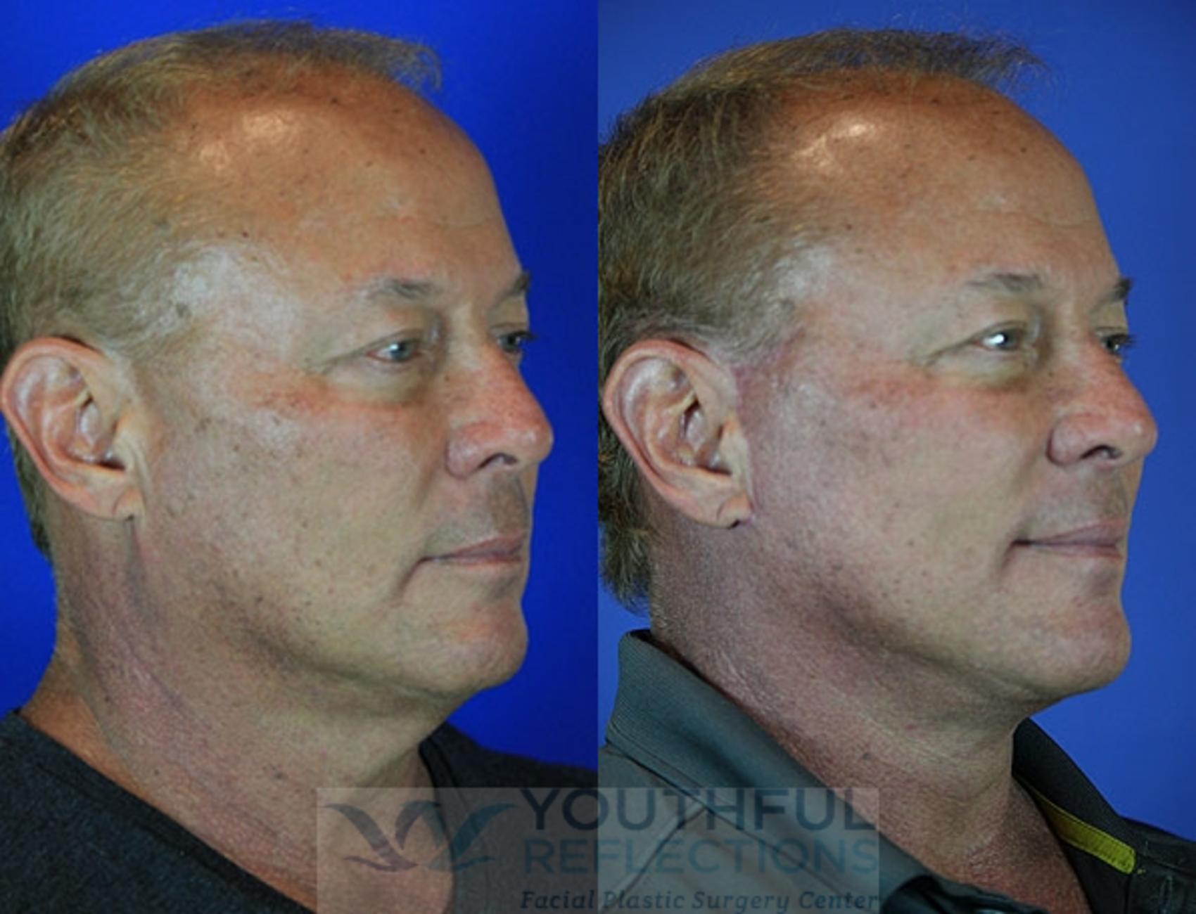 Facelift / Reflection Lift Case 69 Before & After Right Oblique | Nashville, TN | Youthful Reflections